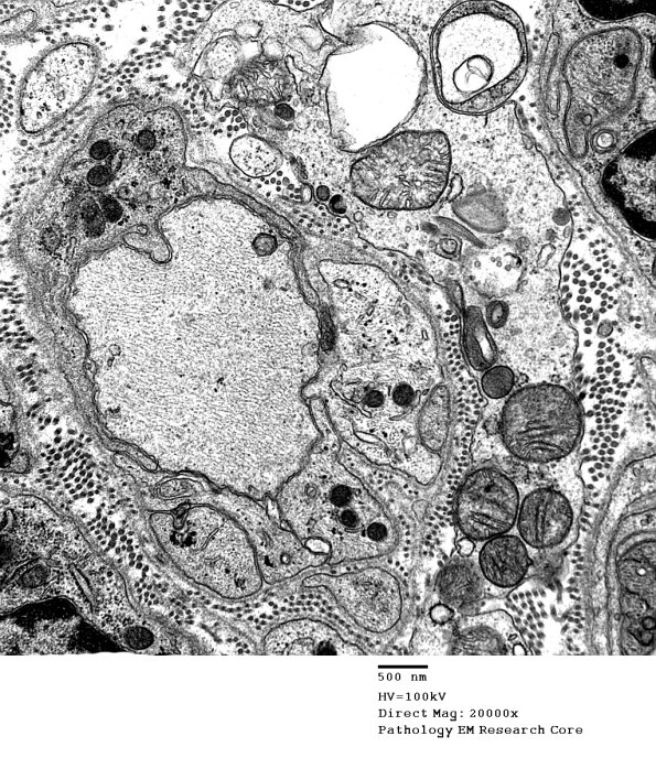 4B3 Demyelination wo remyelination (Case 4) EM 016 - Copy