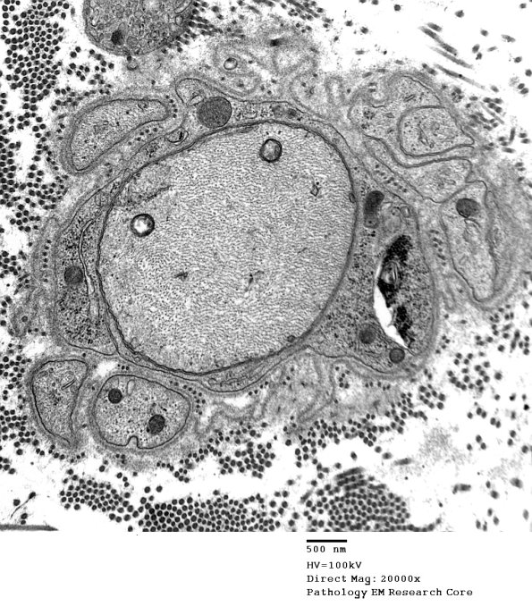 4B4 Demyelination wo remyelination (Case 4) EM 010 - Copy
