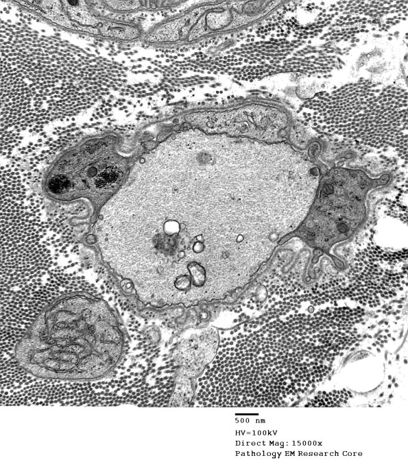 4B5 Demyelination wo remyelination (Case 4) EM 036 - Copy
