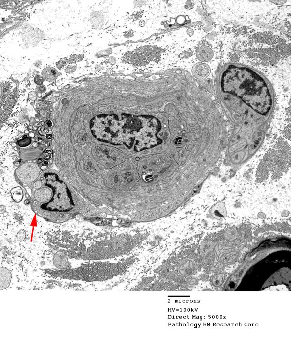 4B6 Demyelination wo remyelination (Case 4) EM 044 copy - Copy