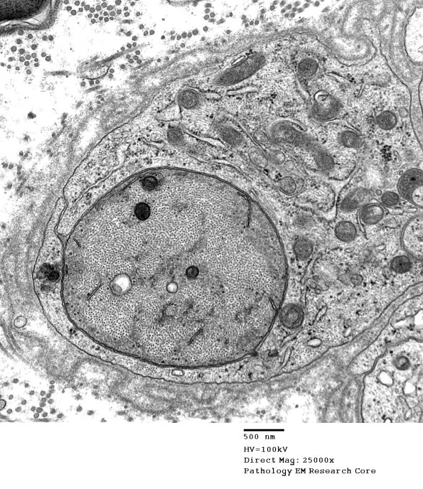 4B7 Demyelination wo remyelination (Case 4) EM 052 - Copy