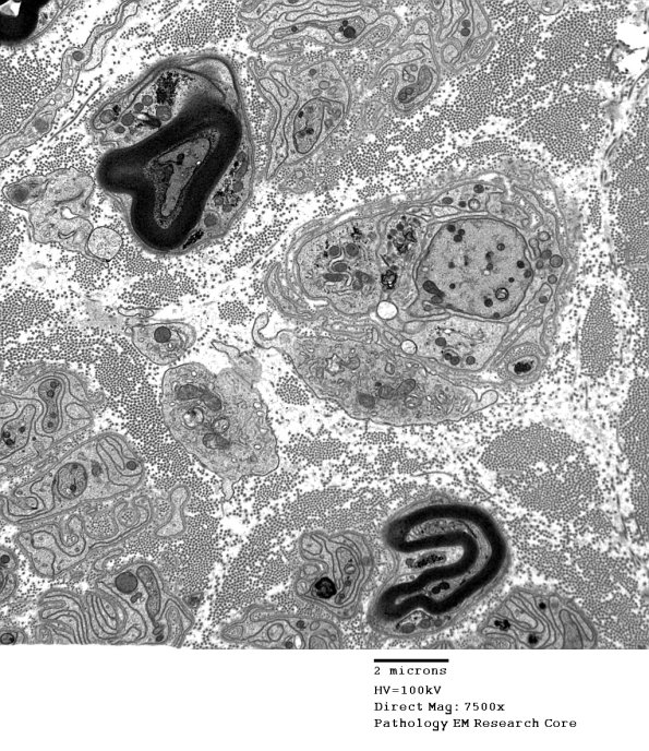 4B8 Demyelination wo remyelination (Case 4) EM 053 - Copy