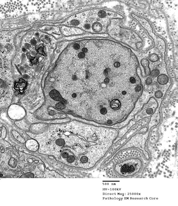 4B9 Demyelination wo remyelination (Case 4) EM 054 - Copy