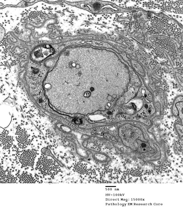 4C1 Demyelination wo remyelination (Case 4) EM 072 - Copy