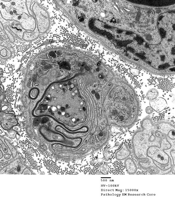 4C2 Demyelination wo remyelination (Case 4) EM 018 - Copy