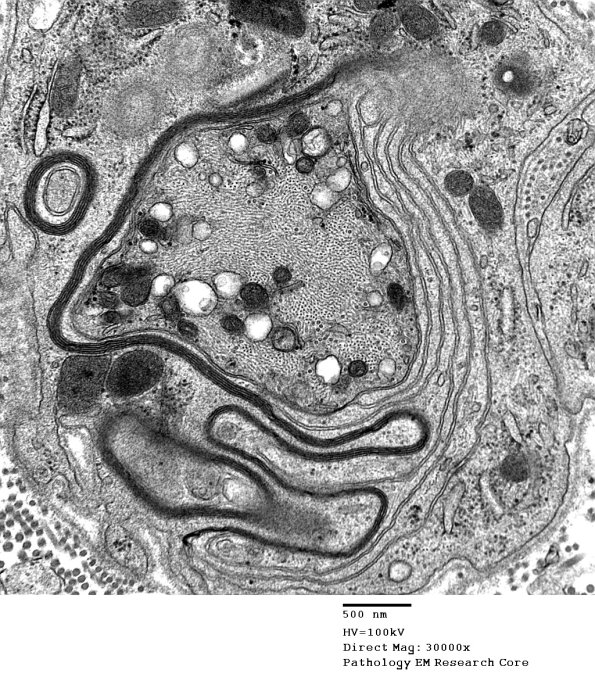 4C3 Demyelination remyelination (Case 4) EM 019 - Copy