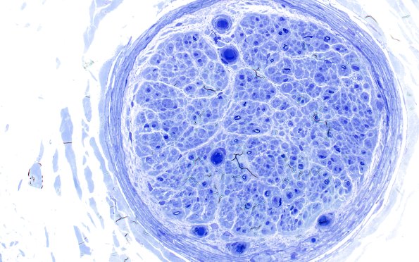 5A1 Demyelination (Case 5) Plastic 40
