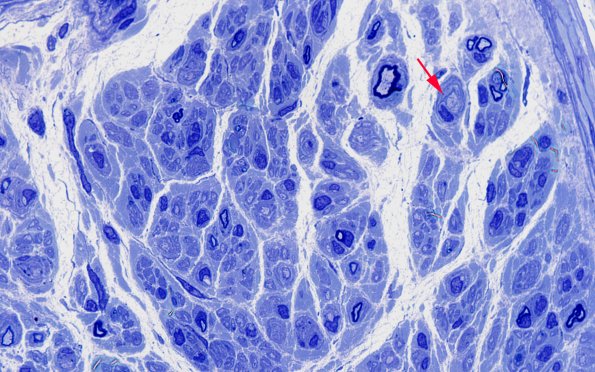 5A2 Demyelination (Case 5) Plastic 100X 4 copy