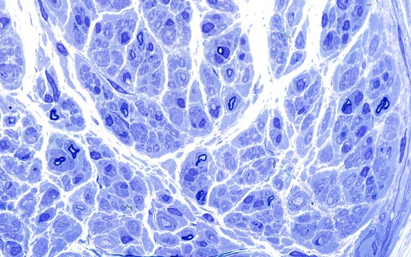 5A3 Demyelination (Case 5) Plastic 100X 3