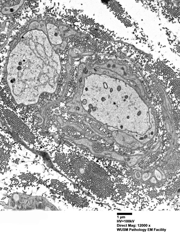 5B1 (Case 5) EM 005 - Copy