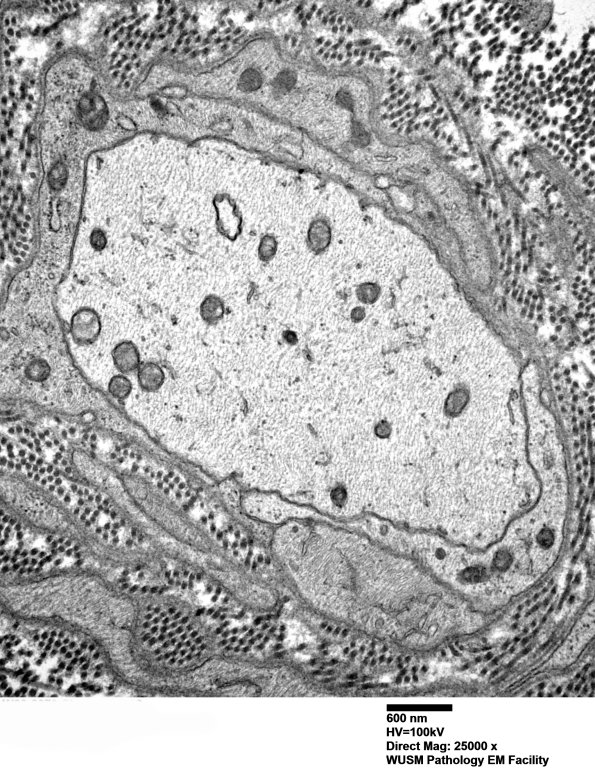5B2 (Case 5) EM 006 - Copy