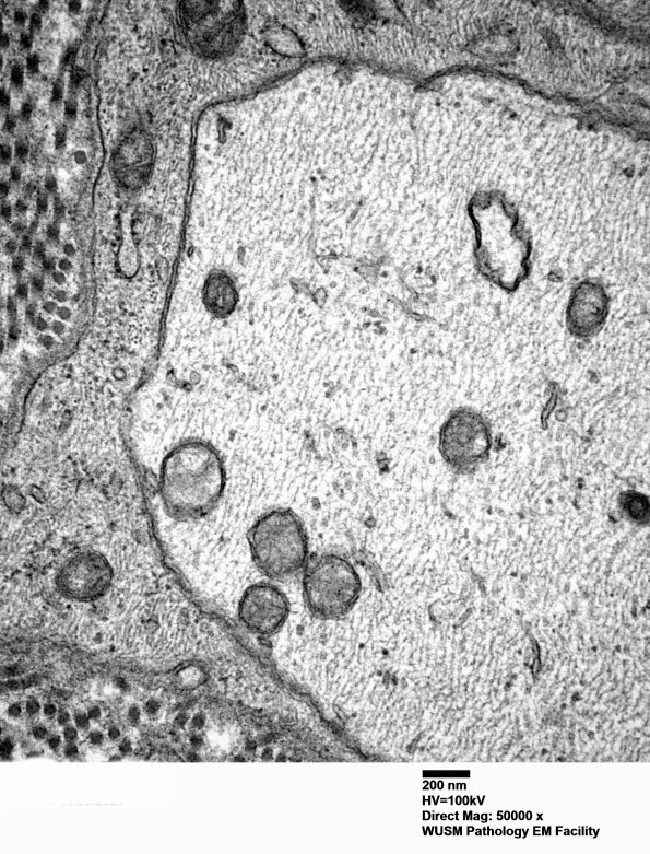 5B3 (Case 5) EM 009 - Copy