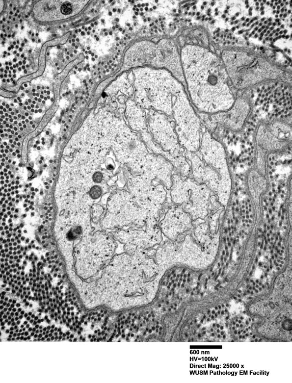 5B4 (Case 5) EM 007 - Copy
