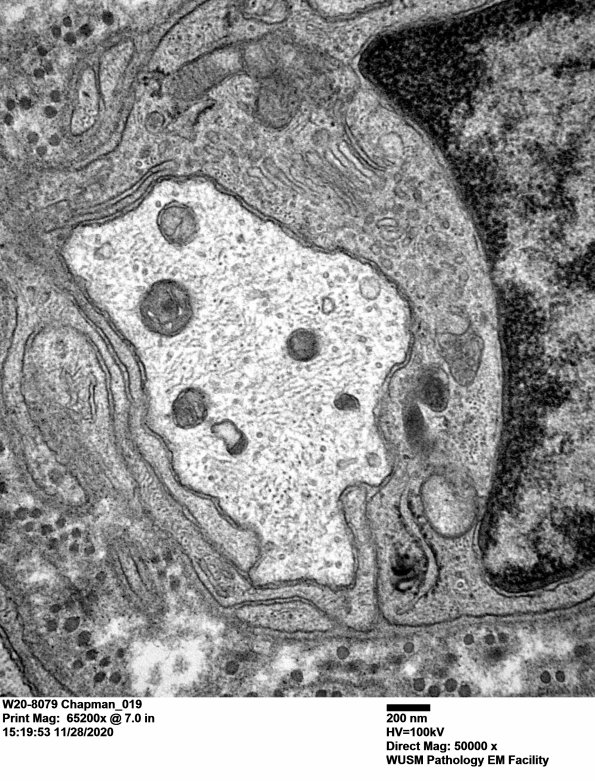 5B6 (Case 5) EM 019 - Copy