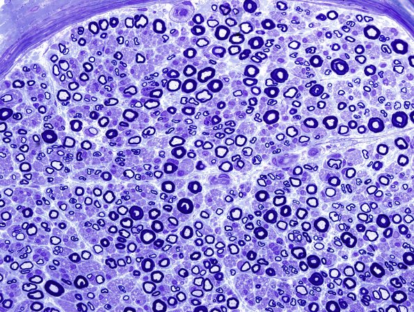 6A1 Demyelination (Case 6) Plastic 1.jpg