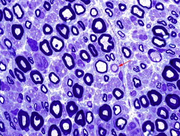 6A2 Demyelination (Case 6) Plastic 4 copy.jpg
