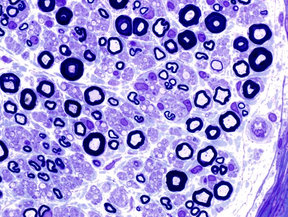 6A3 Demyelination (Case 6) Plastic 12.jpg