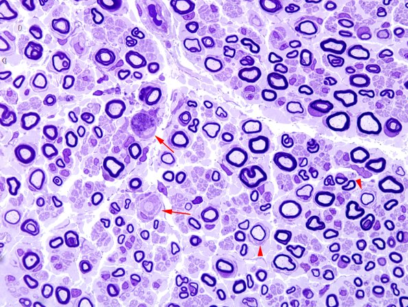 7A Demyelination (Case 7) Plastic 2 copy.jpg