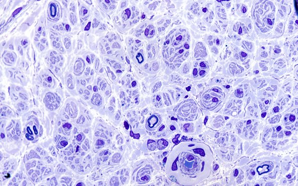 10A1 (Case 10) 100X sp GBS. 1