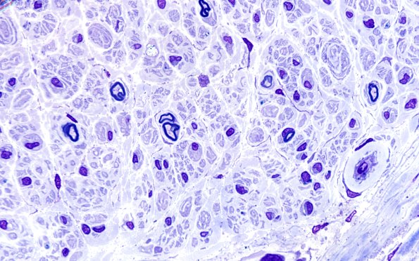 10A2 (Case 10) 100X sp GBS. 2