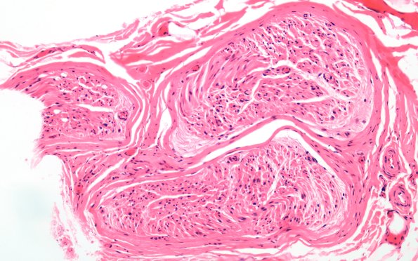 1A GBS, (Case 1) H&E 20X