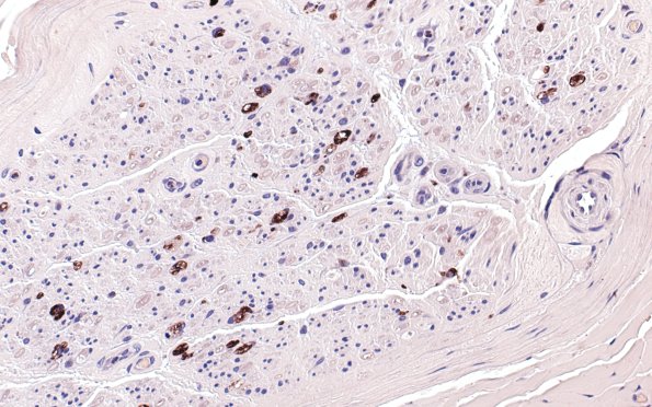 1B1 GBS, (Case 1) KP1 40X 2