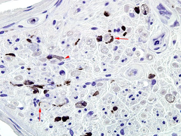 1B2 GBS (Case 1) CD68 6 copy.jpg