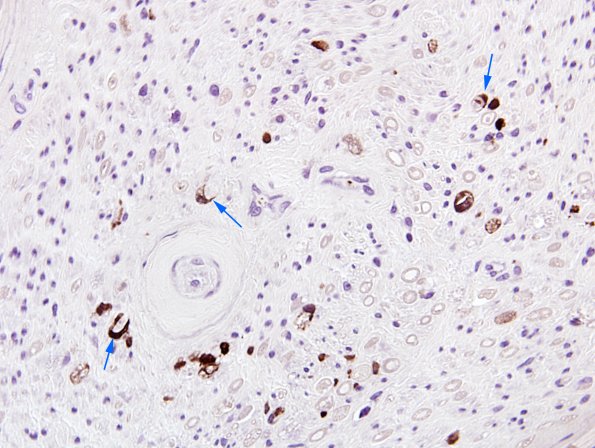 1B3 GBS (Case 1) CD68 1 copy.jpg