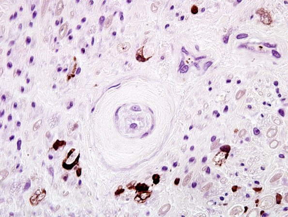 1B4-GBS-Case-1-CD68-4.jpg