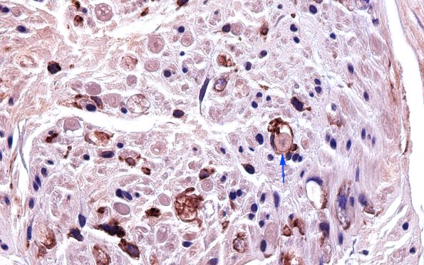 1B5 GBS, (Case 1) CD45 100X 6 copy