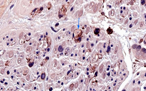 1B6 GBS, (Case 1) CD45 100X 8 copy