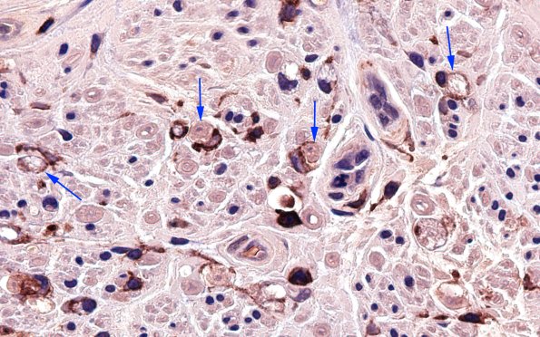 1B7 GBS, (Case 1) CD45 100X 9 copy