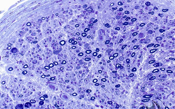 1C1 GBS, (Case 1) Plastic 40X