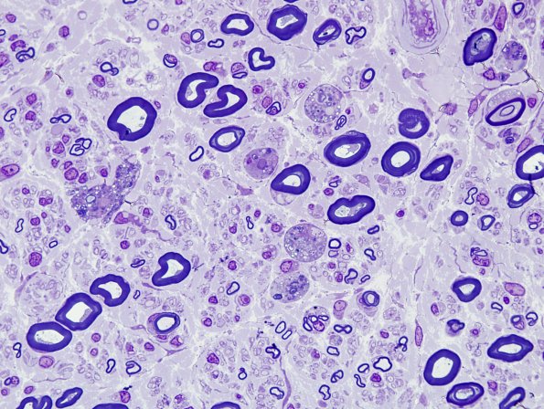 1C3 GBS, (Case 1) max sharpness 1