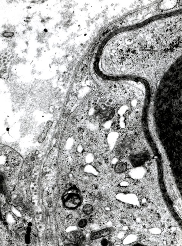 1D4 GBS, (Case 1) EM 2 - Copy A