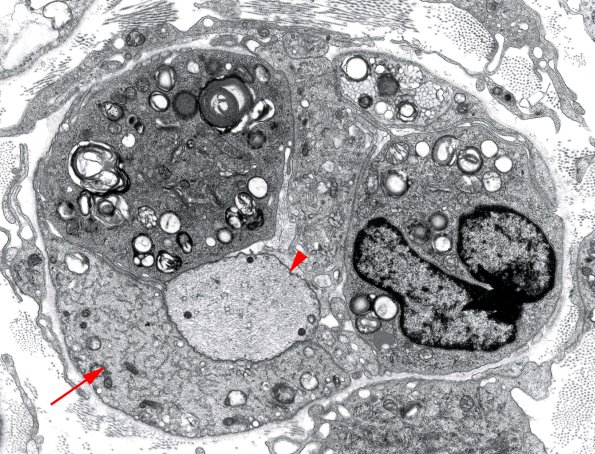 1D5 GBS (Case 1) EM 6 copy - Copy