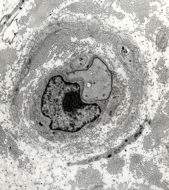 1D8 GBS, (Case 1) EM 7 - Copy