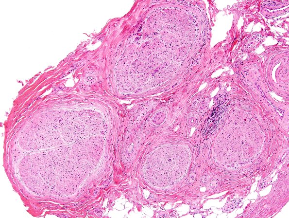 2A1 GBS (Case 2) H&E 1