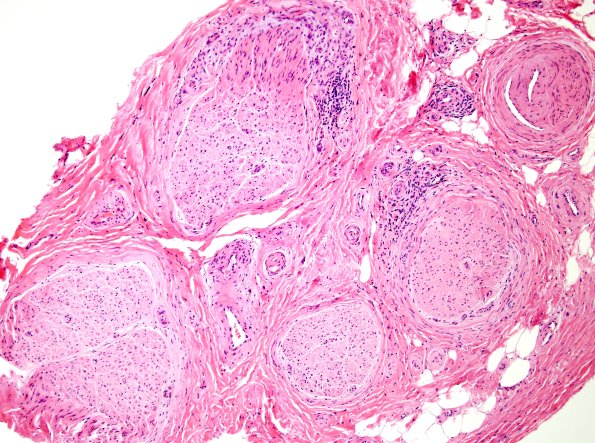 2A2 GBS (Case 2) H&E 4