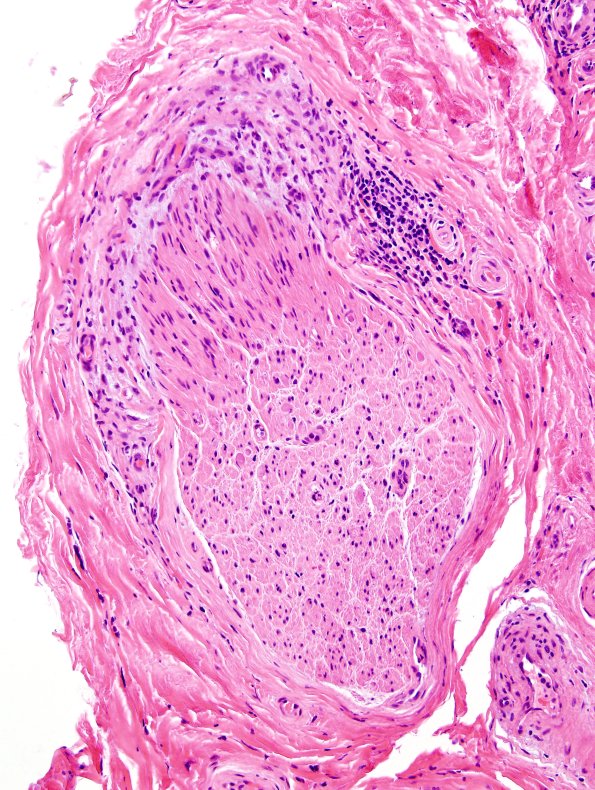 2A3 GBS (Case 2) H&E 2