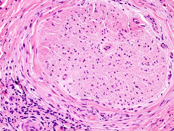 2A4 GBS (Case 2) H&E 3