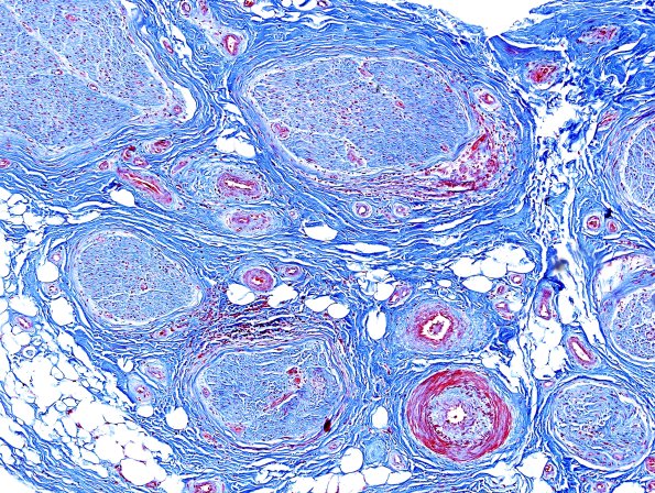 2B GBS (Case 2) Trichrome
