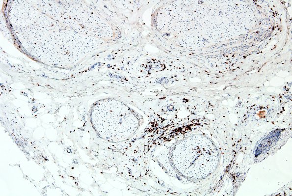 2C1 GBS (Case 2) CD3 1