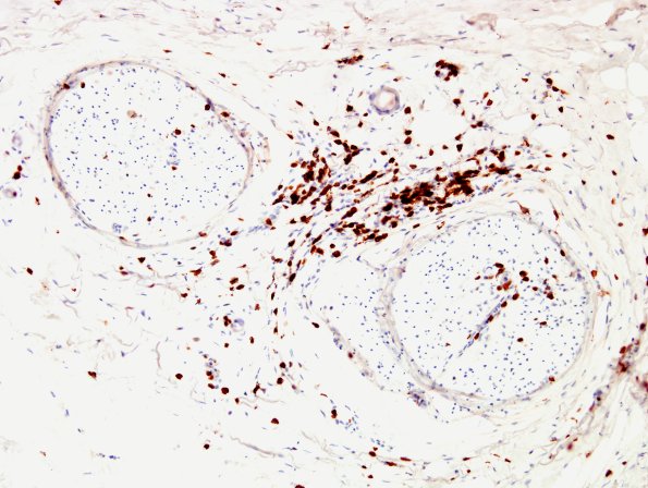 2C2 GBS (Case 2) CD3 3