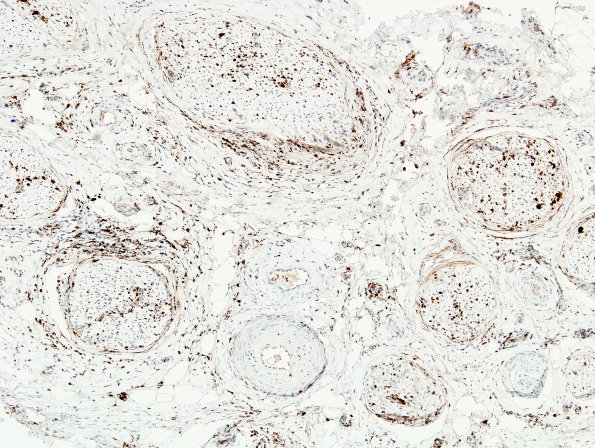 2D1 GBS (Case 2) CD68 8