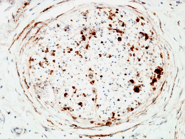 2D2 GBS (Case 2) CD68 4