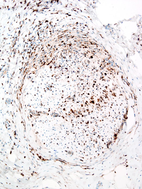 2D3 GBS (Case 2) CD68 6