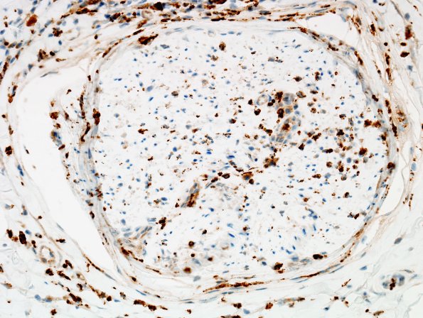 2D4 GBS (Case 2) CD68 1