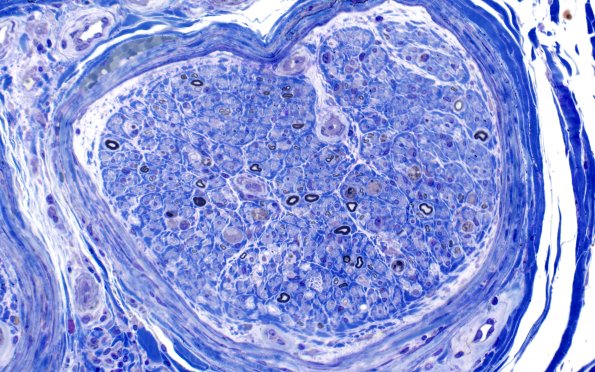 2E1 GBS (Case 2) Plastic 40X