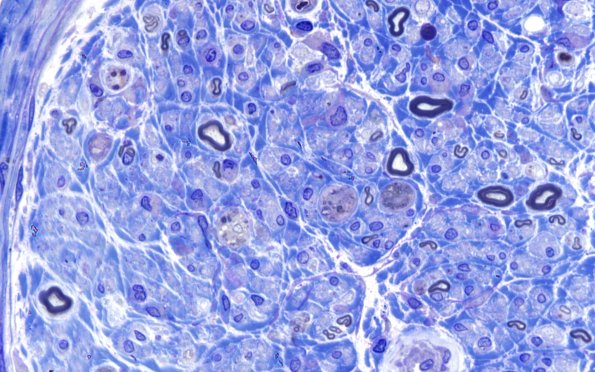 2E3 GBS (Case 2) Plastic 100X 1